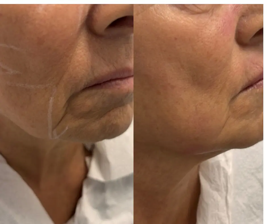 Efekt zabiegu HIFU w klinice DermaElite w Lesznie