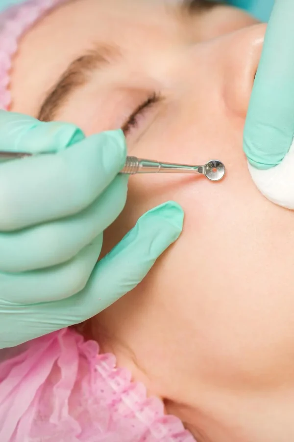 Manualne oczyszczanie twarzy w klinice DermaElite w Lesznie